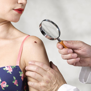 melanoma
