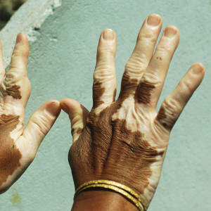 vitiligo